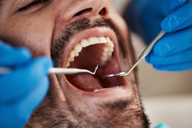 Best Emergency Dental Care for Broken or Chipped Teeth in Saluda, SC